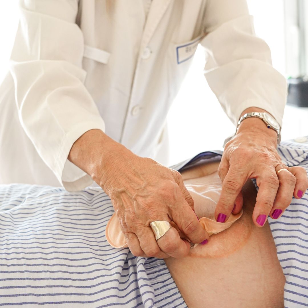 🩹 Guía Completa sobre Ostomías: Cuidados de la Piel y Manejo Domiciliario